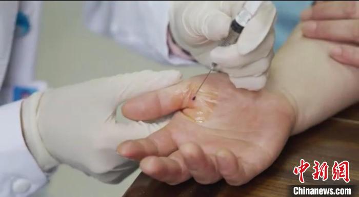 嘉善群眾體驗小針刀?！〖紊平y(tǒng)戰(zhàn) 供圖